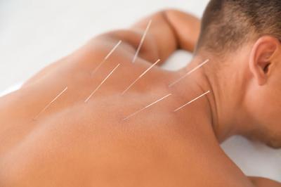 Acupuncture: The Incredible Impact on Your Health