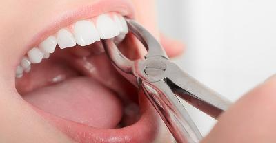 Tooth Extraction in Kitchener | Tooth Removal Near Kitchener