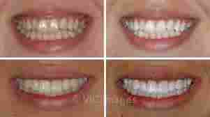 TEETH WHITENING BY XTREMELASHCANADA