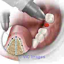 Bend Implant Dentist