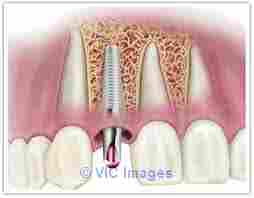 Bend Implant Dentist