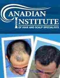 Get FREE $500 credit for Hair Transplant Procedure