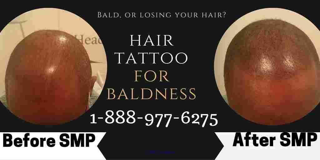 Balding? Get your Hair Back with a Hair Tattoo. Travel to Toronto