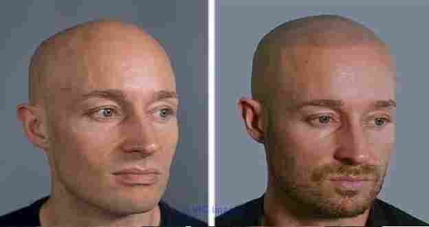 Learn about Scalp Micropigmentation from the Best Hair Tattoo Clinic i