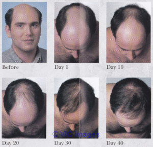 Enjoy a full head of hair in as little as 6 weeks at just $800