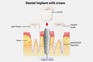 Dental Implants Get Your Misssing Teeth Back