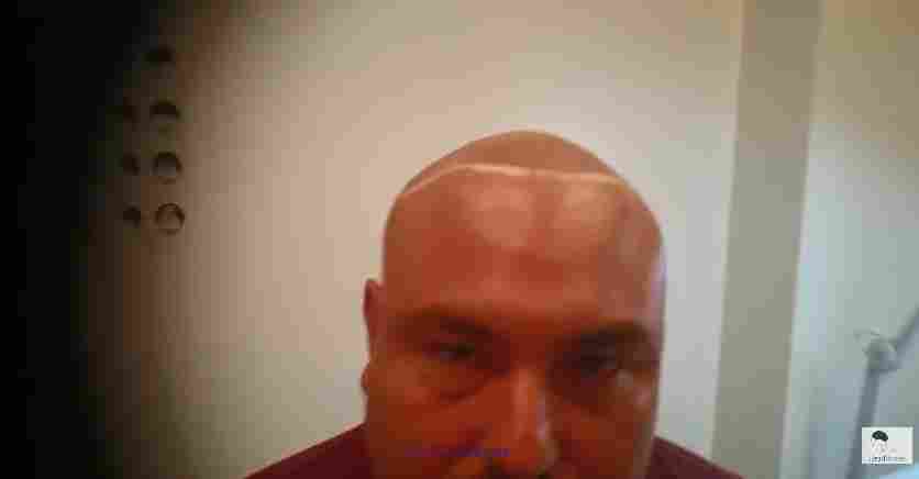 Are you Balding? Get a Hair Tattoo and Get your Confidence Back Now.