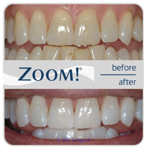 Teeth Whitening At Oasis Dental