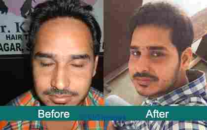 Cost Effective Hair Transplant Treatment Clinic in Sydney