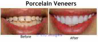 Porcelain Veneers (LUMINEERS) | Oasis Dental Milton