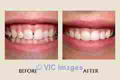 Bonding  Alternative to Veneers | Oasis Dental Milton