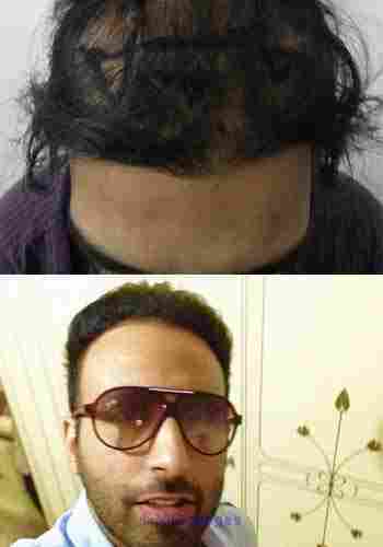 Hair Transplant in Newcastle