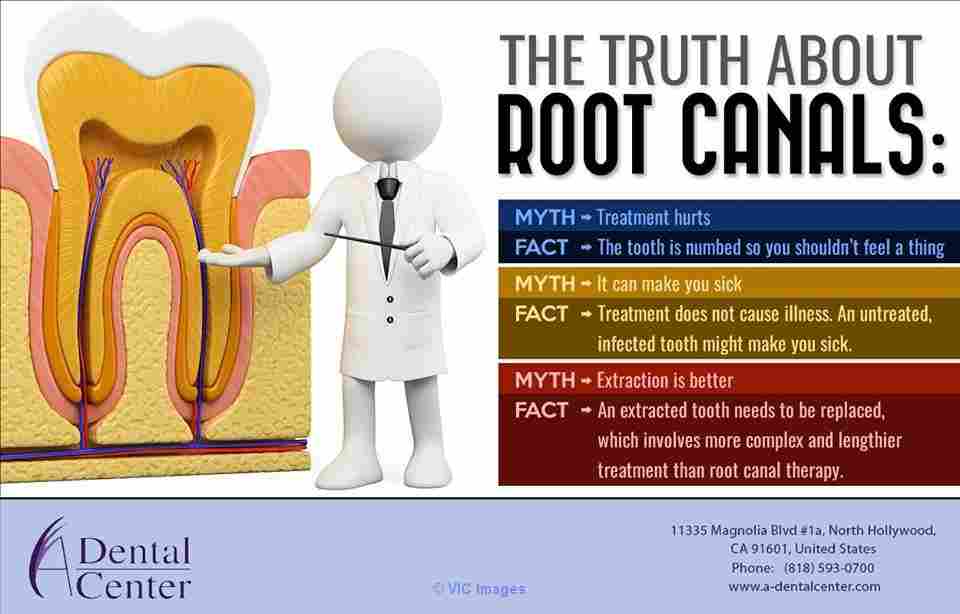Local Root Canal in North Hollywood