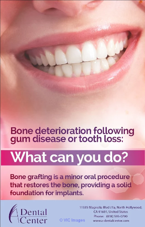 Local Bone Grafting North Hollywood
