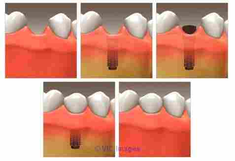 Find Dental Implant Downtown London ON - Dr. David Favell - Local Dent