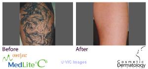 Local Laser Tattoo Removal Toronto- Dr. Sam Hanna For Best Results