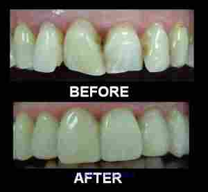 Waterlase Laser Treatment @063555273