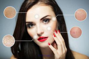 Rosacea treatment edmonton