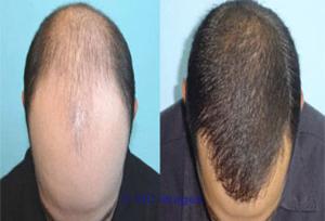Hair Wig Shops in Delhi, Hair Wigs Manufacturer/ Suppliers in Delhi