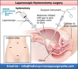Avail Benefits of Laparoscopic Hysterectomy Surgery in India