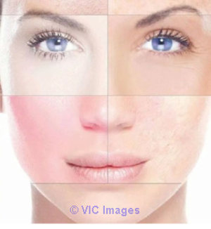 Best skin care products for redness in Alberta
