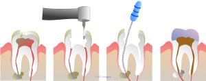 Root Canal Treatment for Infected Tooth