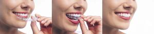 A Straighter Smile with Invisalign