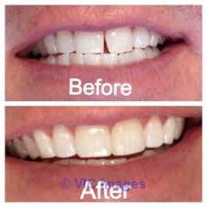 Restorative Dentistry Abbotsford