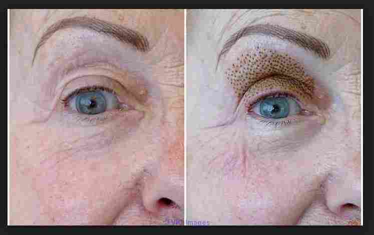 ONLINE FIBROBLAST PLASMALIFT WRINKLE REMOVAL COURSE!