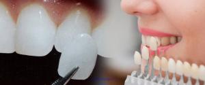 Dental Veneers Treatment at Expressions Dental