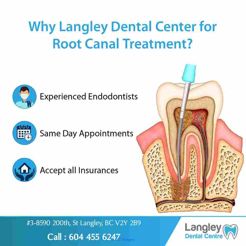 Root Canal Dentist - Langley BC Dentist - Dentist Langley BC
