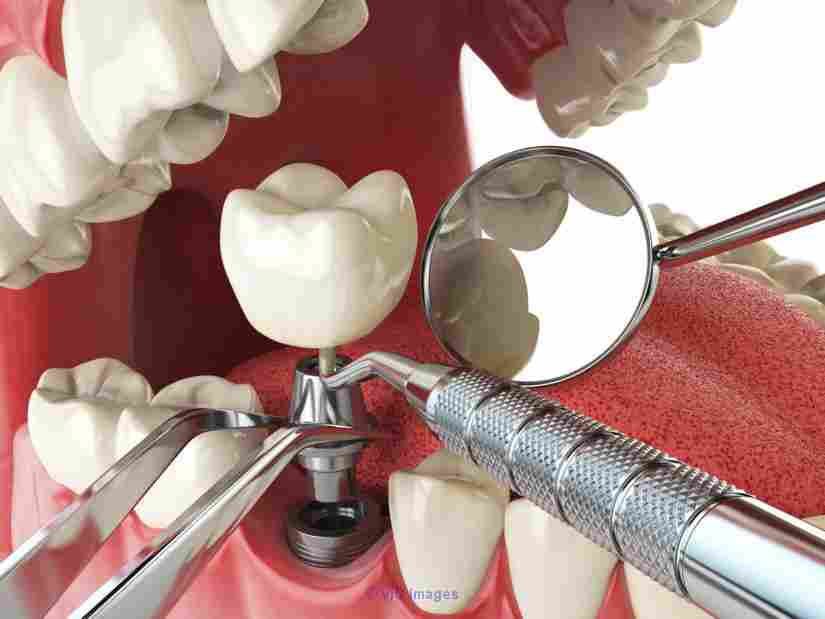 Popular Port Moody Implants Dentist