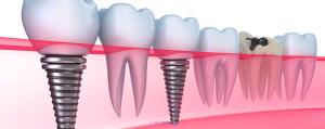 Dental Implant Services in Calgary NW