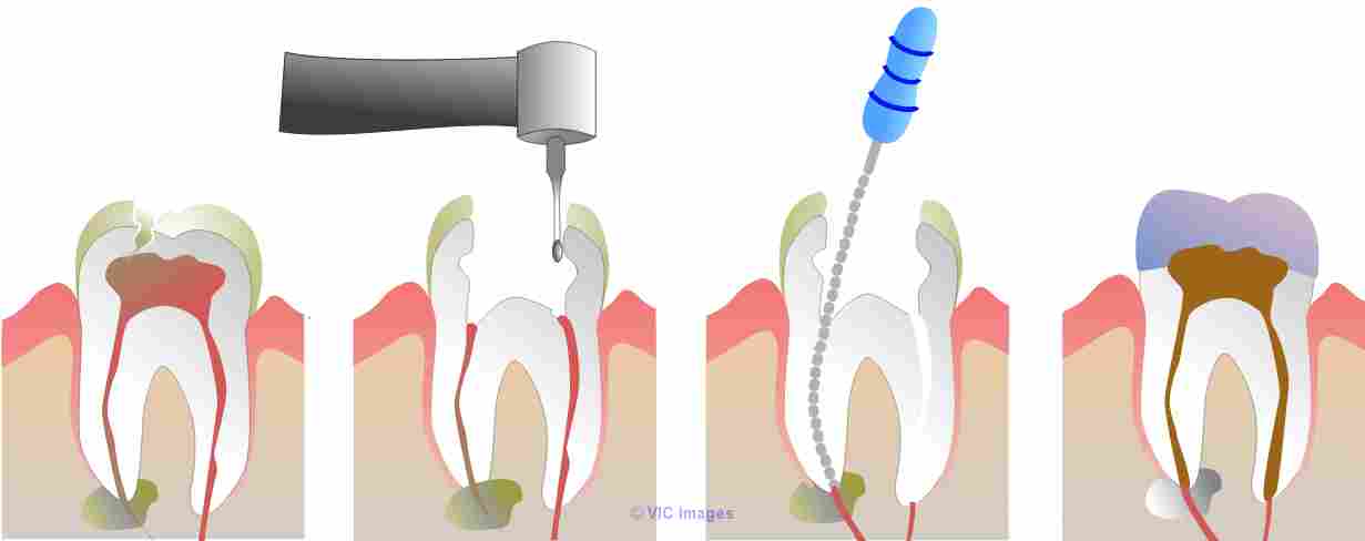 Relieve Your Tooth With Root Canal Therapy