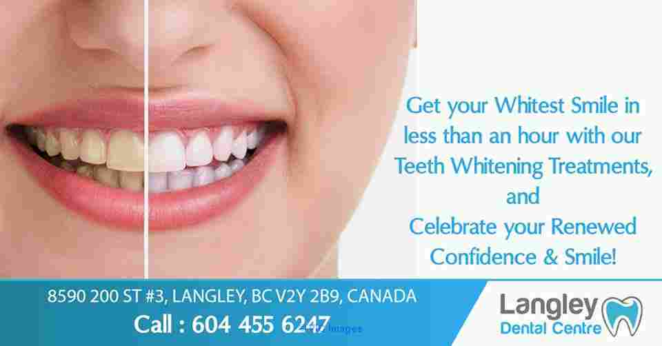 Teeth whitening - Langley Dentist - Dentist Langley BC