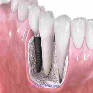 Fill the Unwanted Gap with a Dental Bridge