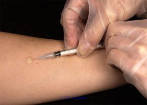 Tuberculous Lymphadenitis (Lymph Node TB)? Diagnostic Test to confirm!