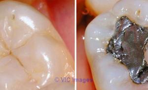 Dental Cleaning in College Station | Toothache in College Station