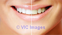 Zoom Teeth Whitening Waterloo