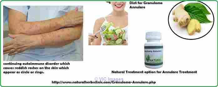 Herbal Treatment for Granuloma Annulare