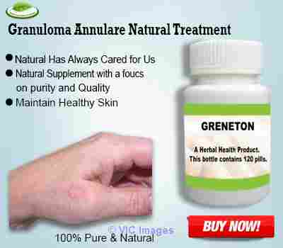 Natural Treatment for Granuloma Annulare