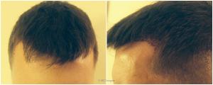 Find Hair Restoration Specialists In Atlanta