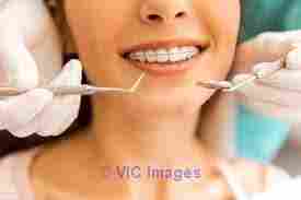 Ray Lawson Dentistry provides patients with Veneer and Bonding service