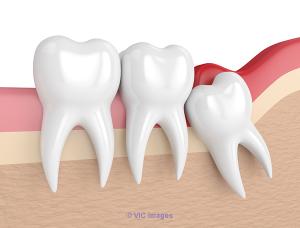 Painless Wisdom Tooth Extraction in Brampton