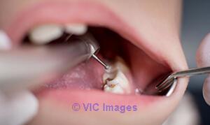 Consult to Implant Dentist
