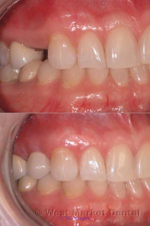 Invisalign In Calgary