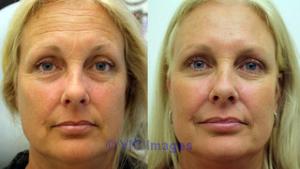 Calgary Botox Clinic -REFIRM