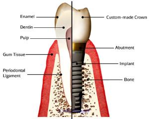 Implant Dentist Canada