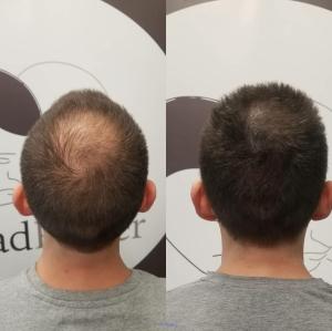 Men and women with hair loss, Contact us for a guaranteed solution.