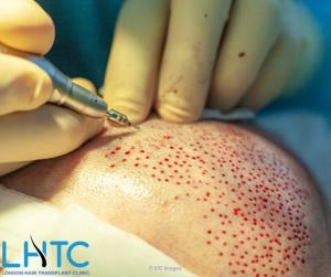 Best Hair Transplant Clinic in London